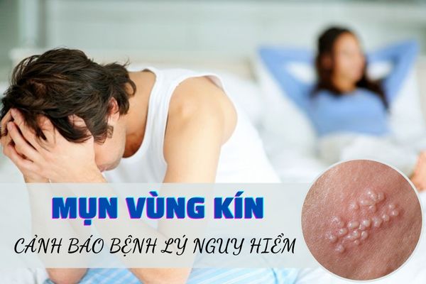 Nổi mụn vùng kín – Dấu hiệu cảnh báo nhiều bệnh lý nguy hiểm