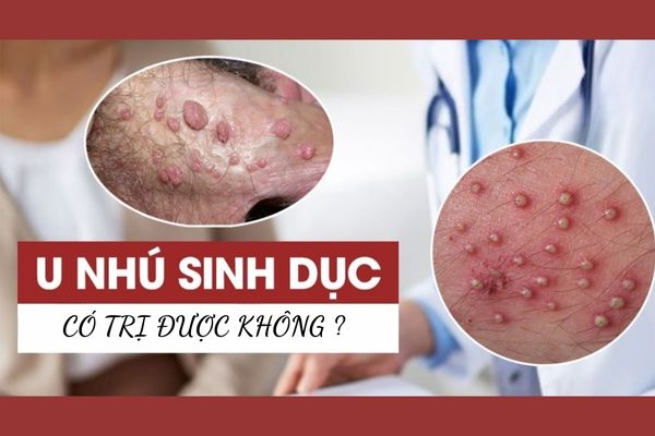 U nhú sinh dục là gì? Có điều trị được không?