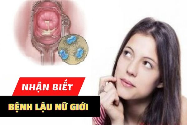 Triệu chứng bệnh lậu nữ giới và cách điều trị hiệu quả