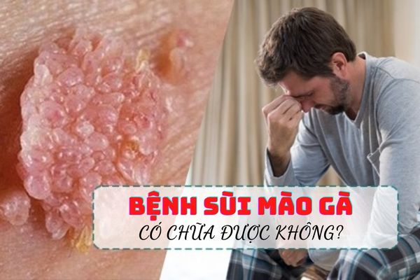 Bệnh Sùi Mào Gà Là Gì, Có Chữa Được Không?