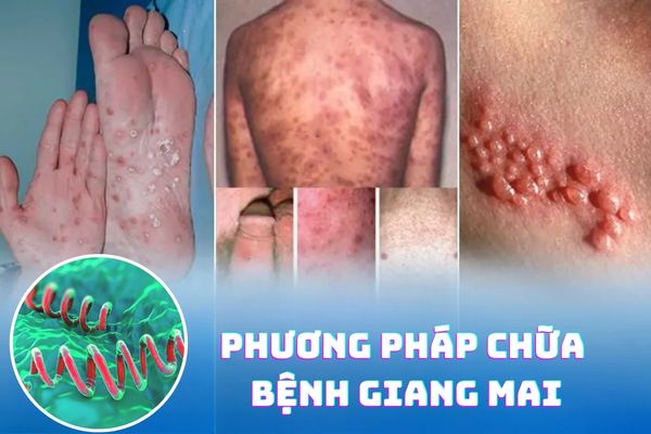 Phương pháp chữa bệnh giang mai hiệu quả – Chi phí điều trị bao nhiêu?