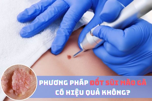 Phương pháp đốt sùi mào gà có hiệu quả không?