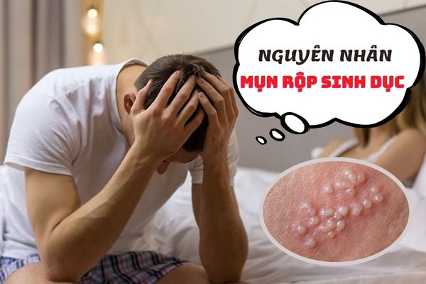 Nguyên nhân mụn rộp sinh dục – Cách điều trị hiệu quả