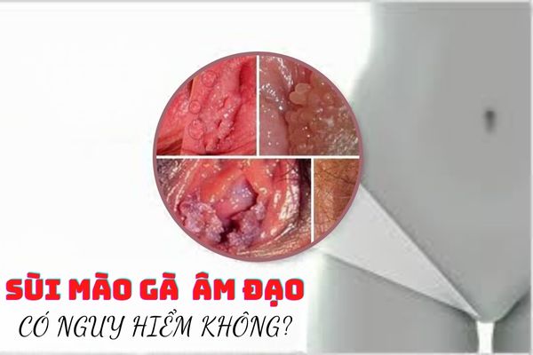 Sùi mào gà ở âm đạo nữ giới có nguy hiểm không?