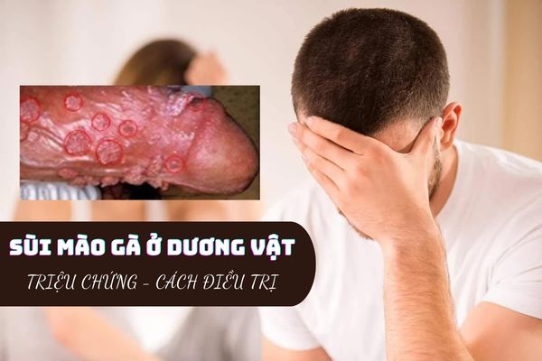 Sùi mào gà ở dương vật – Dấu hiệu nhận biết và cách điều trị