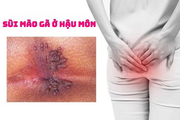 Nhận biết sùi mào gà ở hậu môn – Cách điều trị hiệu quả