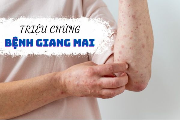 Triệu chứng bệnh giang mai như thế nào? Có nguy hiểm không?