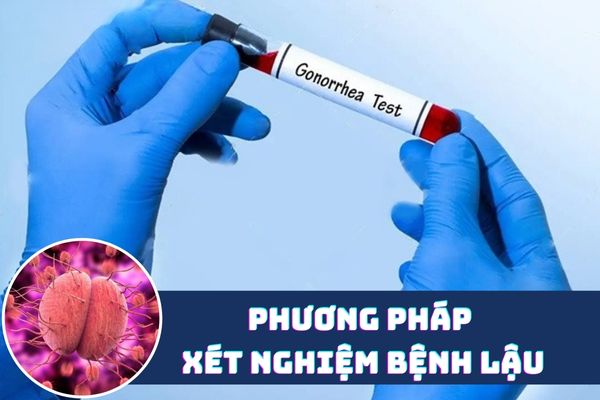 Các phương pháp xét nghiệm bệnh lậu hiệu quả, chuẩn xác