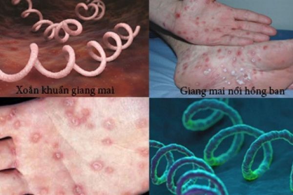 Xet-nghiem-giang-mai-1