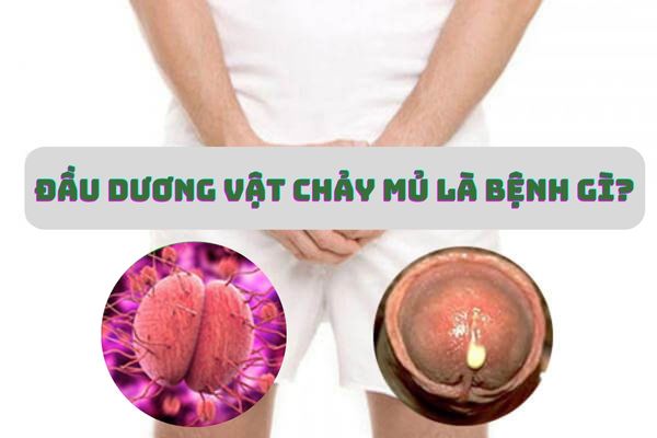 Đầu dương vật chảy mủ – Dấu hiệu cảnh báo bệnh lậu nguy hiểm