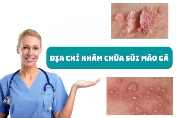 Gợi ý địa chỉ khám chữa sùi mào gà uy tín và an toàn