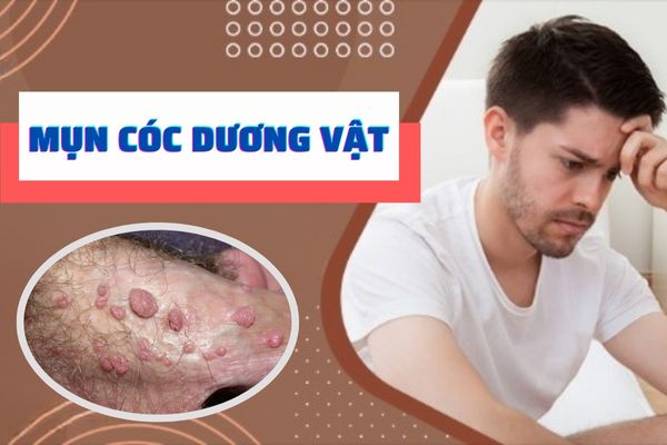 Nhận biết mụn cóc dương vật – Cách điều trị hiệu quả