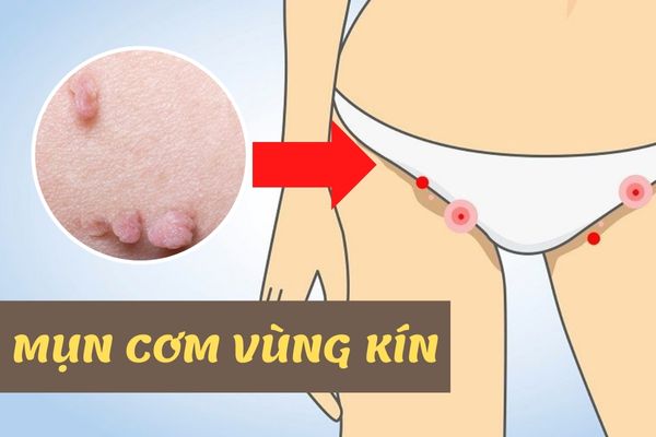Mụn cơm vùng kín là gì? Có nguy hiểm không?