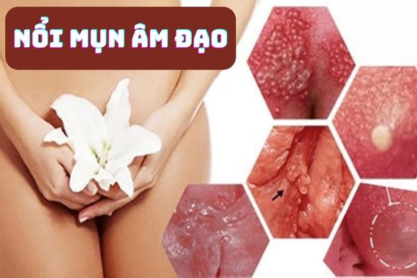 Nổi mụn âm đạo – Cảnh báo nhiều bệnh xã hội nguy hiểm