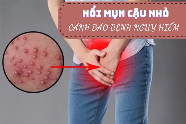 Nổi mụn cậu nhỏ do đâu? Phương pháp khắc phục hiệu quả