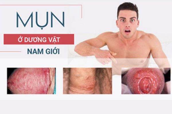 Cảnh báo bệnh lý khi nổi mụn dương vật bất thường