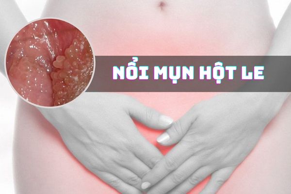 [Giải đáp] Nổi mụn hột le do đâu và cách điều trị hiệu quả
