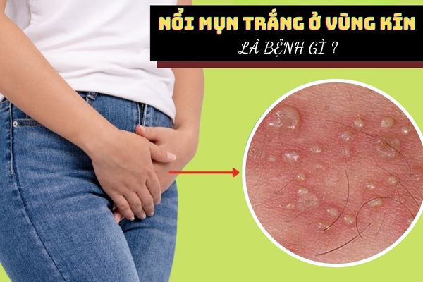 Nổi mụn trắng ở vùng kín là dấu hiệu của bệnh gì?