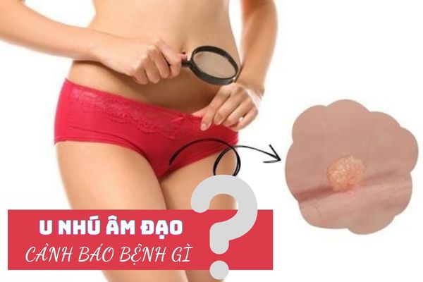U nhú âm đạo ở nữ giới cảnh báo bệnh lý gì? Cách điều trị hiệu quả