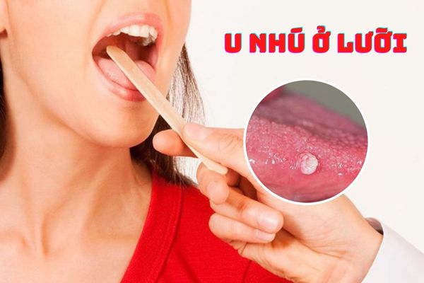 U nhú ở lưỡi cảnh báo bệnh lý gì? Có nguy hiểm hay không?