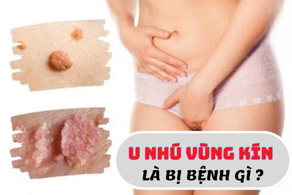 U nhú vùng kín là biểu hiện của bệnh gì?
