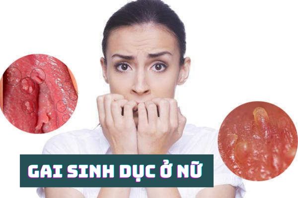 Gai sinh dục ở nữ: Nguyên nhân, triệu chứng và cách điều trị