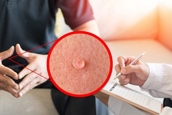 Địa chỉ điều trị mụn cơm sinh dục uy tín, chất lượng