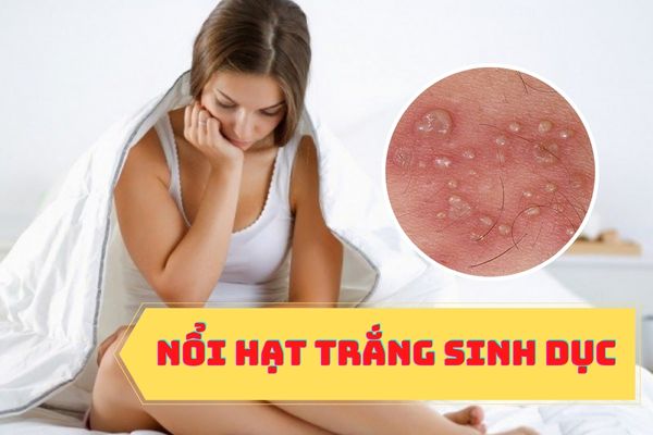 Nổi hạt trắng sinh dục là bị bệnh gì?