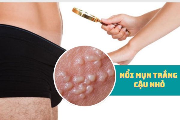 Nổi mụn trắng cậu nhỏ là biểu hiện của bệnh gì?