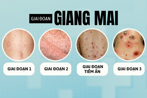 Giang-mai-khong-chi-dai-dang-ma-con-rat-nguy-hiem-2