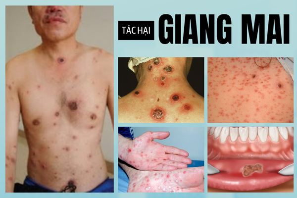 Giang-mai-khong-chi-dai-dang-ma-con-rat-nguy-hiem-3