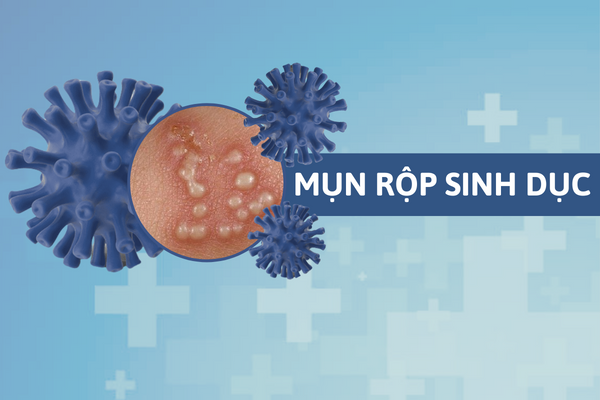 Mun-rop-sinh-duc-tuong-mun-mu-don-gian-nhung-lai-cuc-nguy-hiem-0