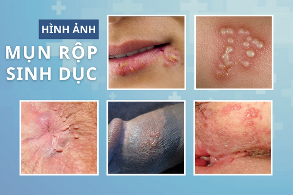 mun-rop-sinh-duc-tuong-mun-mu-don-gian-nhung-lai-cuc-nguy-hiem-2