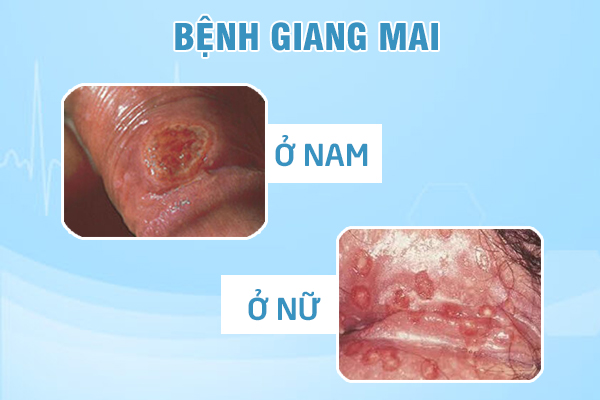 dieu-tri-giang-mai-5