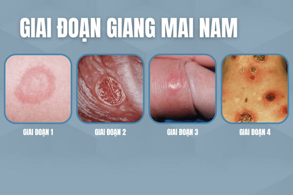giang-mai-o-nam-gioi