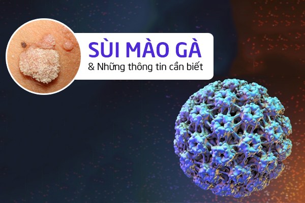 Sùi mào gà và những thông tin cần biết