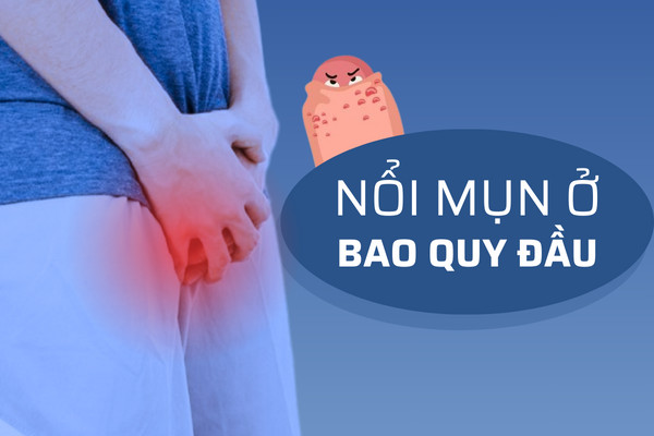 Nổi mụn ở bao quy đầu – nguyên nhân và cách điều trị hiệu quả