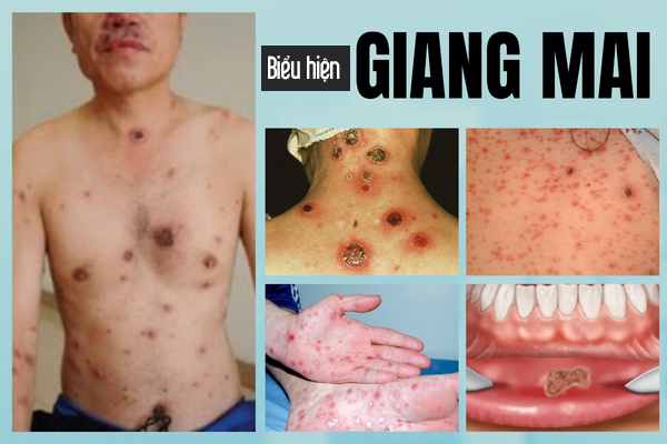 benh-giang-mai-co-chua-duoc-khong-3