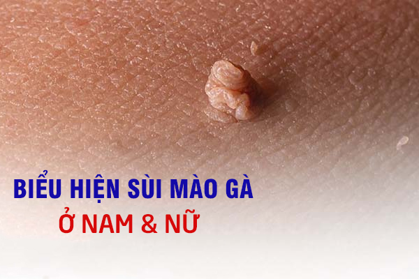 Nhận biết sớm các biểu hiện sùi mào gà và cách chữa trị