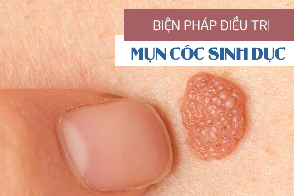 Chữa mụn cóc sinh dục bằng phương pháp nào hiệu quả?