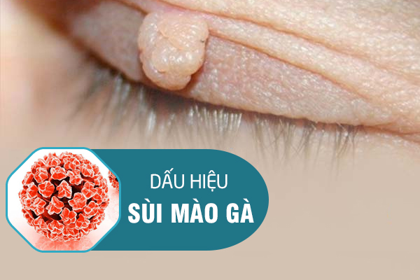 Dấu hiệu sùi mào gà như thế nào?