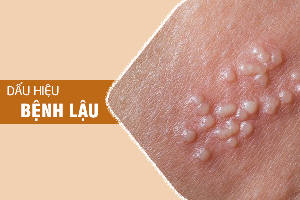 Bác sĩ hướng dẫn nhận biết dấu hiệu bệnh lậu ở nam và nữ giới