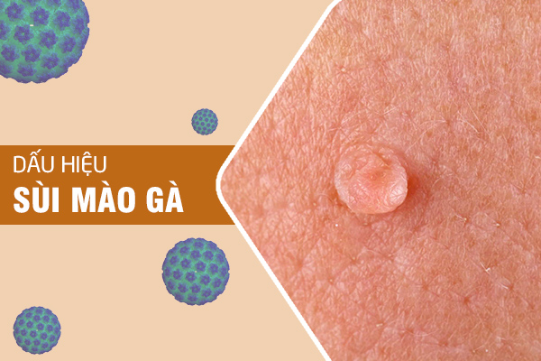 dau-hieu-sui-mao-ga-4