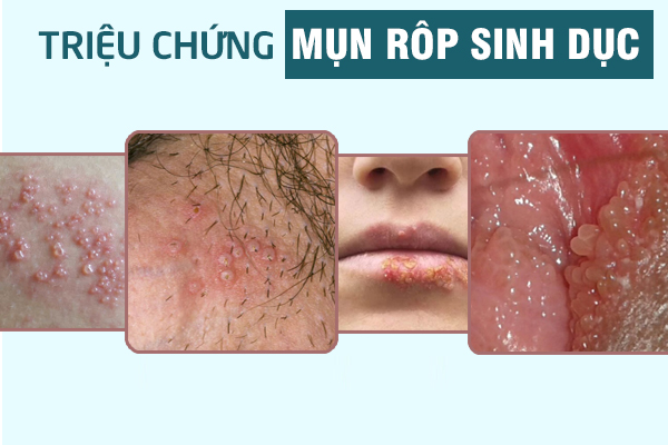 dia-chi-chua-mun-rop-sinh-duc-1