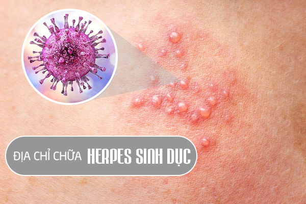 Địa chỉ chữa mụn rộp sinh dục hiệu quả, uy tín tại Hải Dương