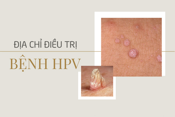 Địa chỉ chữa bệnh HPV an toàn, chính xác tại tỉnh Hải Dương