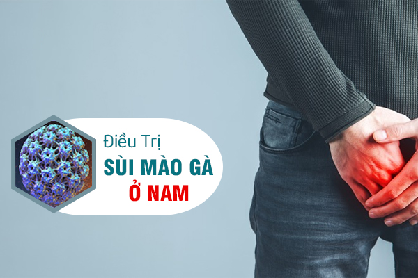 Cách chữa và địa chỉ điều trị sùi mào gà ở nam hiệu quả