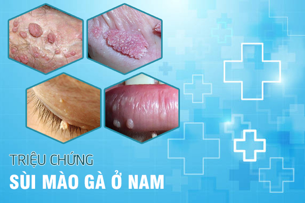 dieu-tri-sui-mao-ga-o-nam