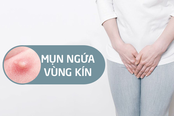 Nổi mụn ngứa vùng kín – Dấu hiệu cảnh báo bệnh lý nguy hiểm