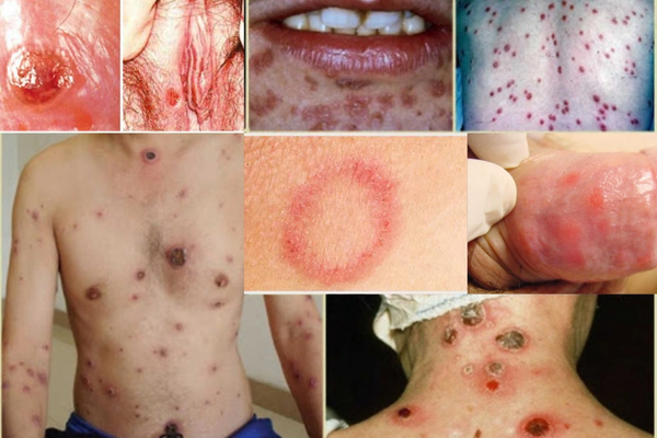 dau-hieu-benh-giang-mai-nam-nu